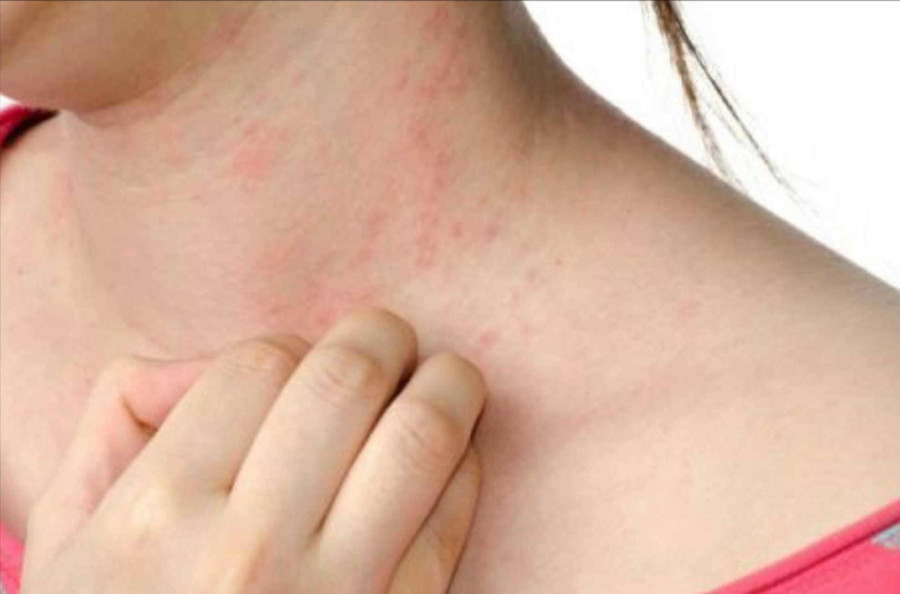 POSTAJE PANDEMIJA Alergije na hranu imaju ogromne razmere