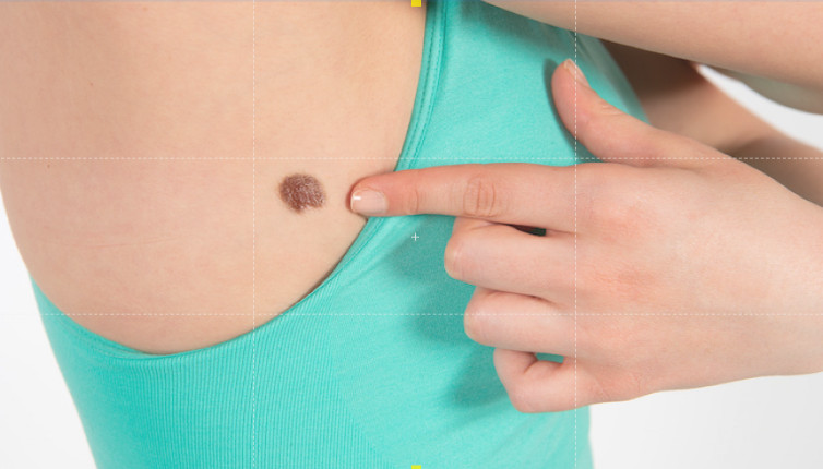 OBELEŽAVA SE MESEC BORBE PROTIV MELANOMA Besplatni dermatološki pregledi i u manjim sredinama