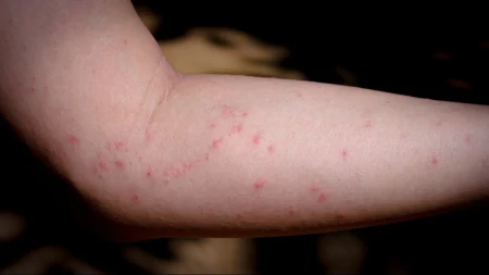 Ne možete da prestanete da se češete - jedan trik pomaže kod uboda insekata 